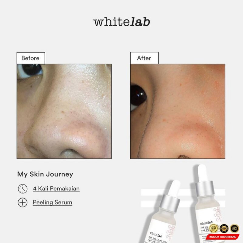 Serum Eksfoliasi