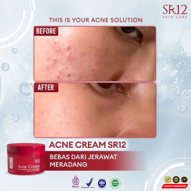Acne Cream Mengatasi Jerawat - Image 8