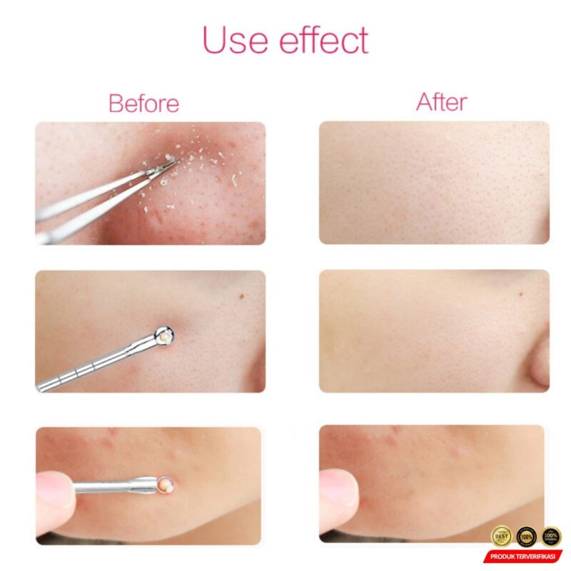 Biutte.co Alat Perlengkapan Komedo Jerawat Blackhead 3 PCS - [MRH2] - Image 5