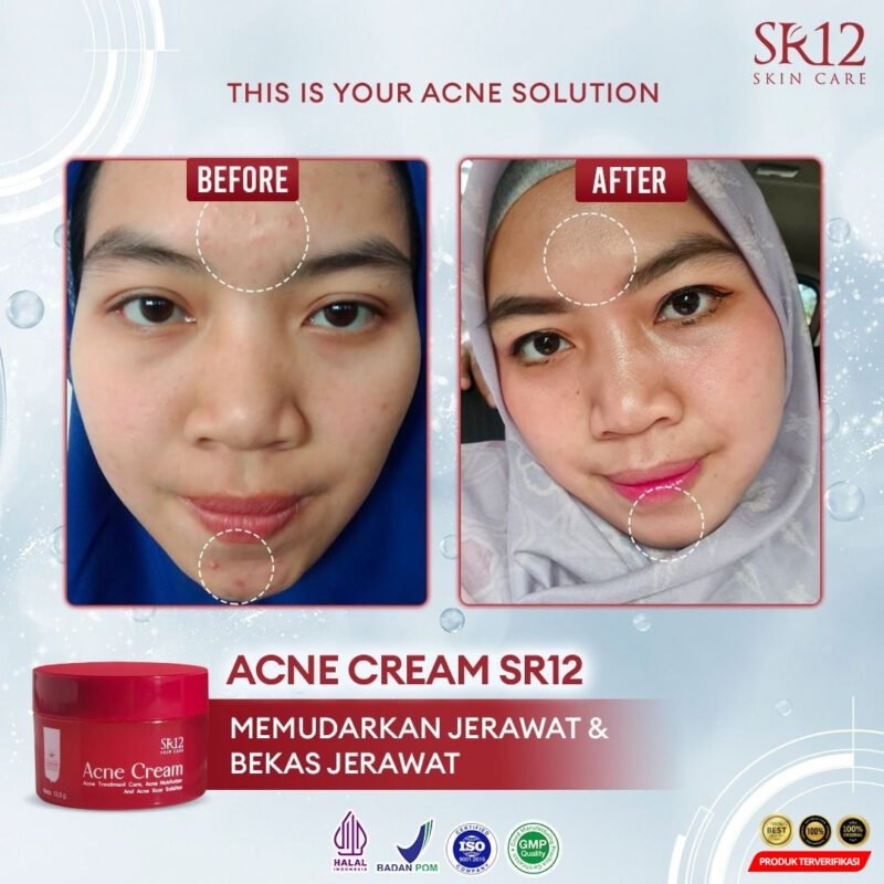 Acne Cream Mengatasi Jerawat - Image 9