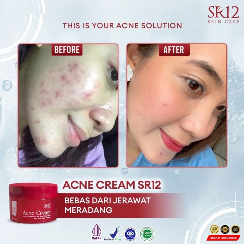 Acne Cream Mengatasi Jerawat - Image 10